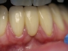1d-philip-3-units-zirconium-bridge-after-4-years-in-situ