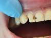 composite-before-after-3