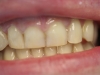 composite-before-after-4