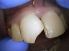 composite-before-after-5