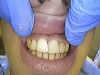 composite-before-after-6