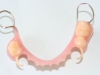 partial-dent-with-d-clasps-in-visable-area