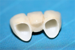 A dental bridge