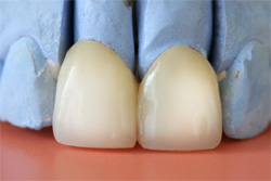 Crowns