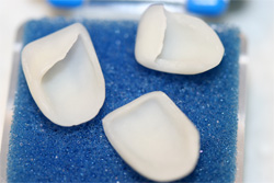 Veneers